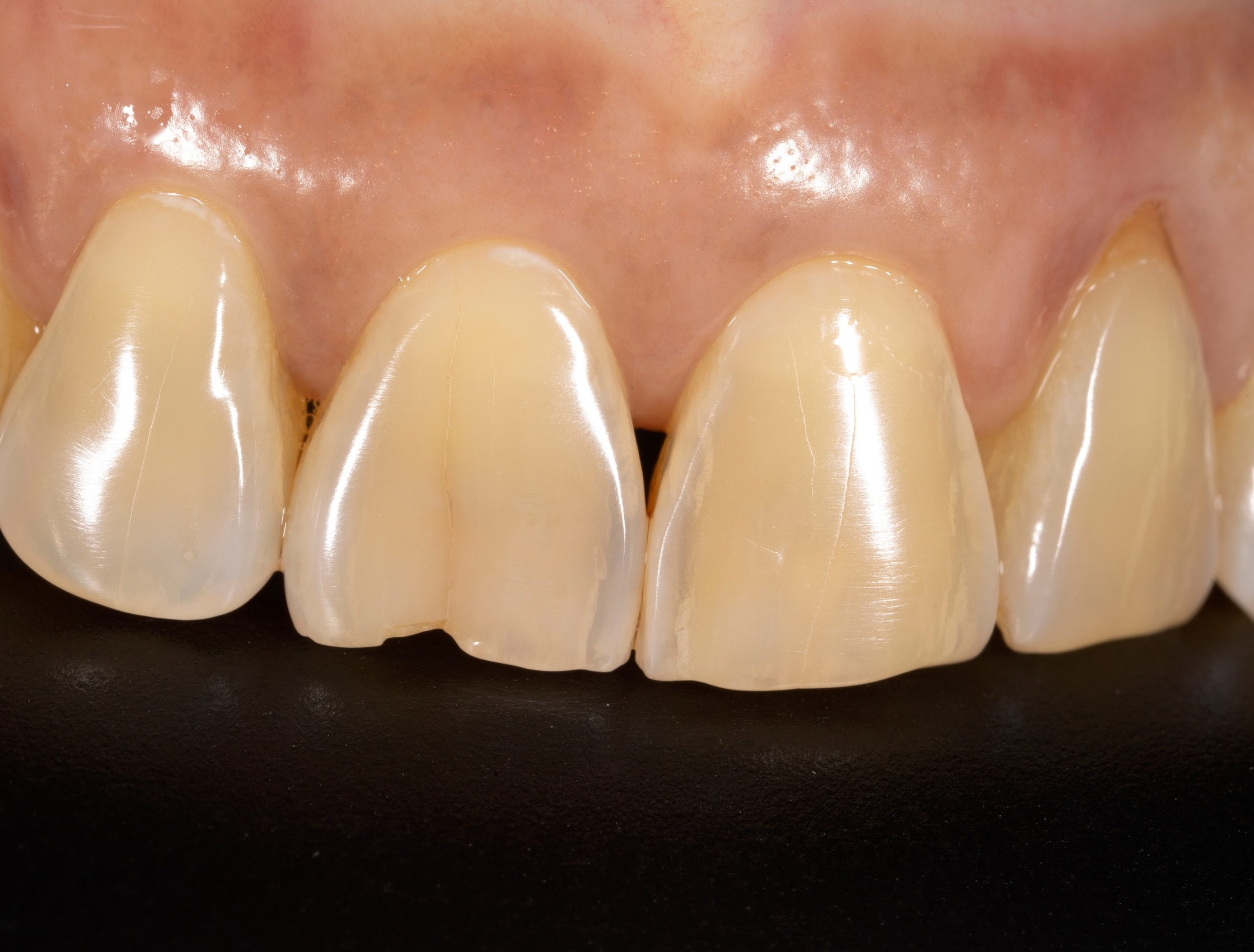 chipped tooth emergency dentist nottingham