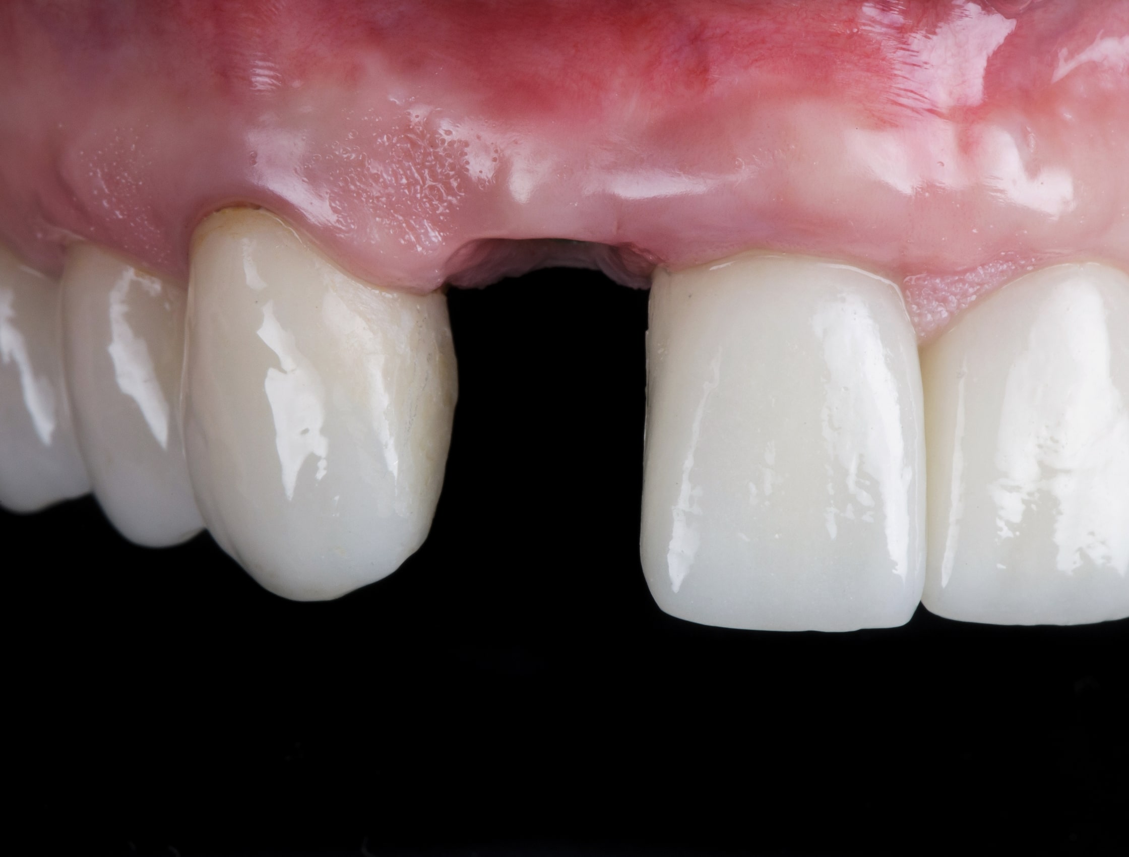 knocked out tooth emergency dentist nottingham