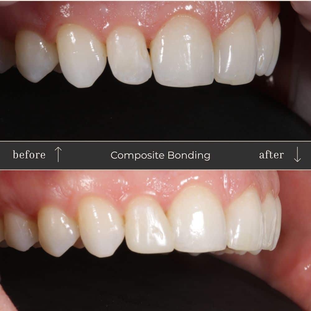 Composite Bonding Before & After