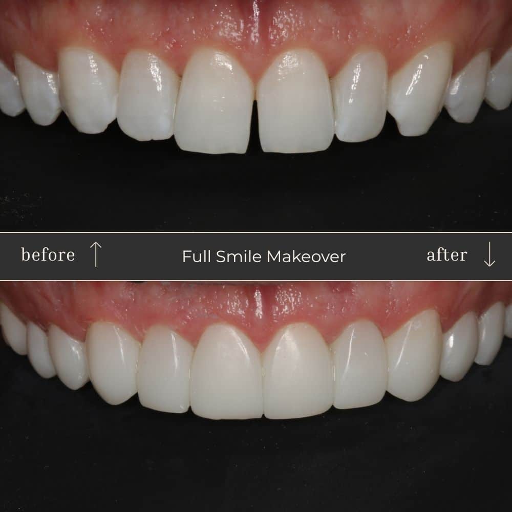 Composite Bonding Before & After