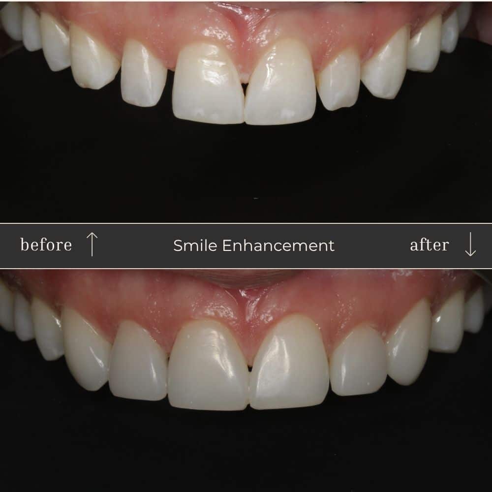 Composite Bonding Before & After
