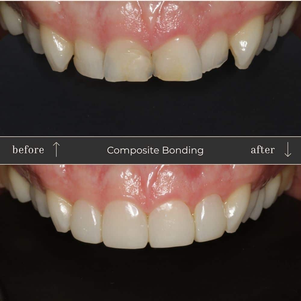 Composite Bonding Before & After