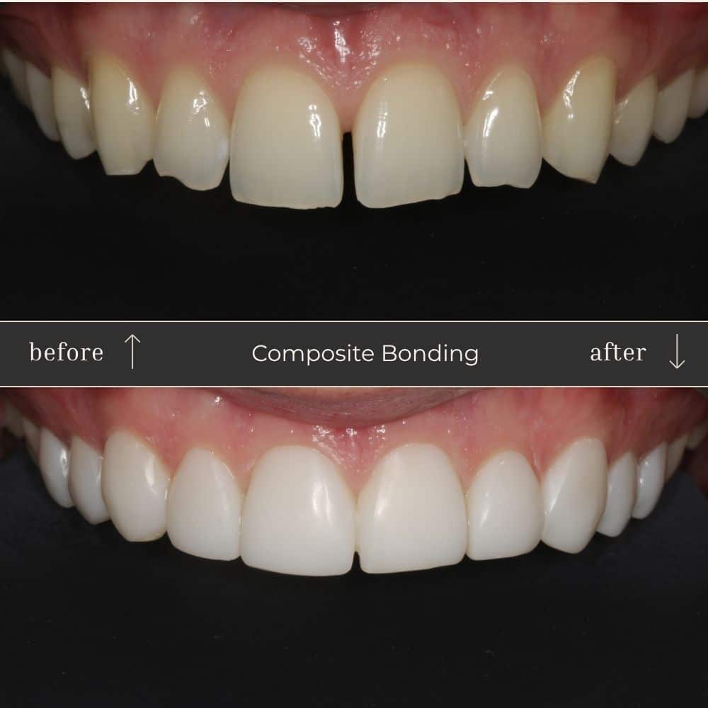 Composite Bonding Before & After