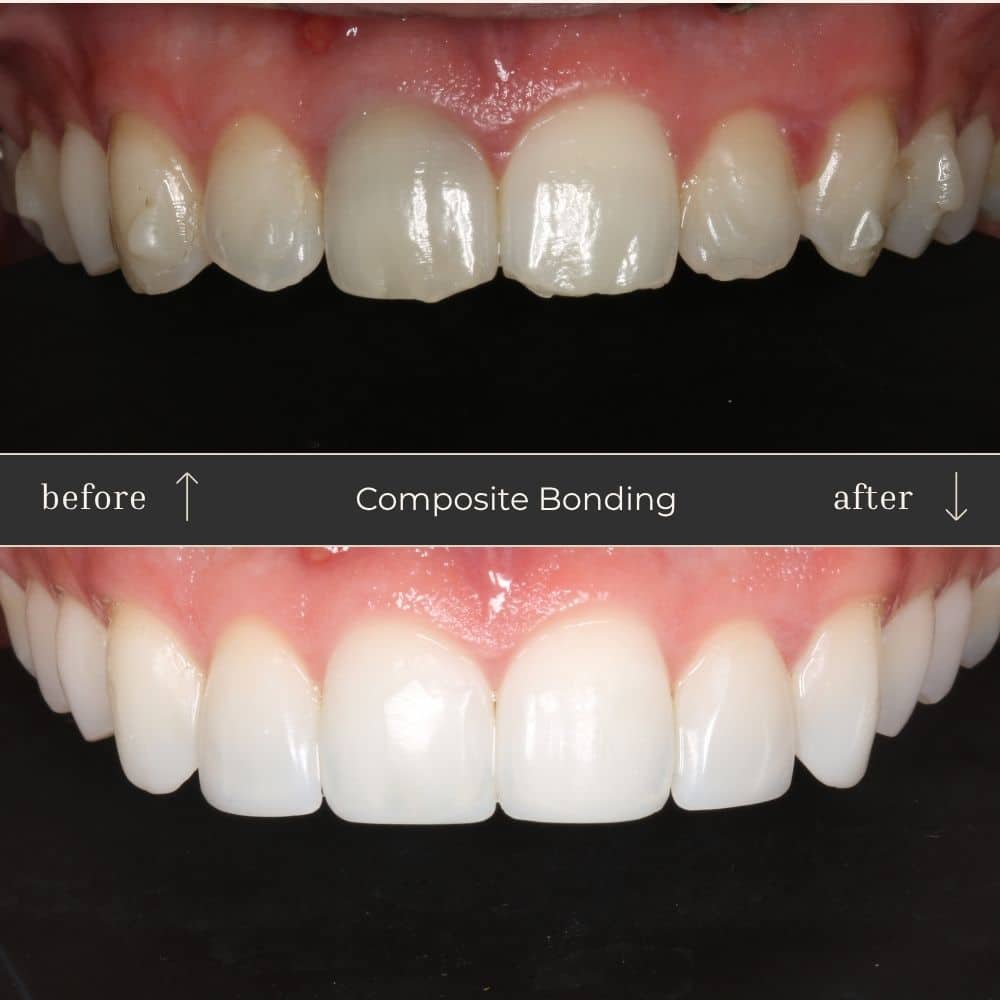 Composite Bonding Before & After