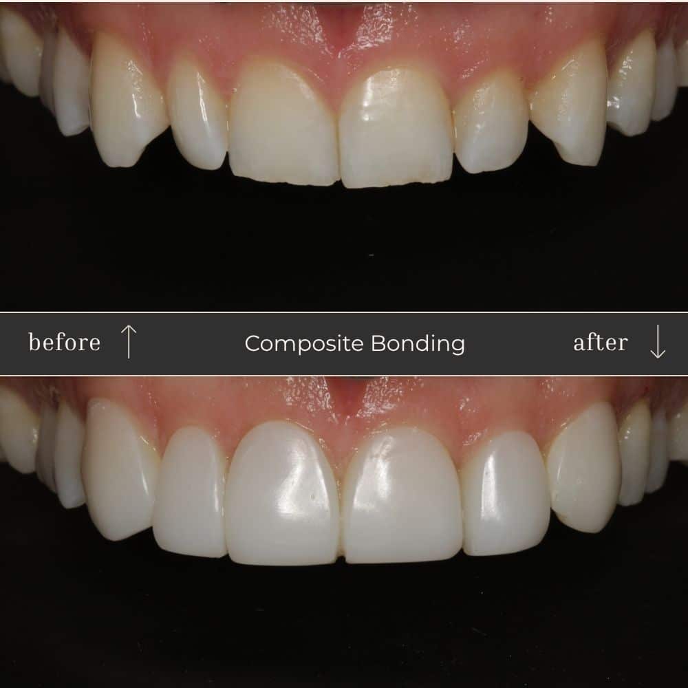 Composite Bonding Before & After
