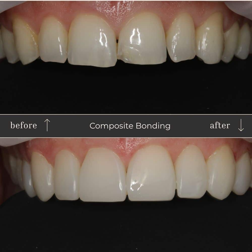 Composite Bonding Before & After