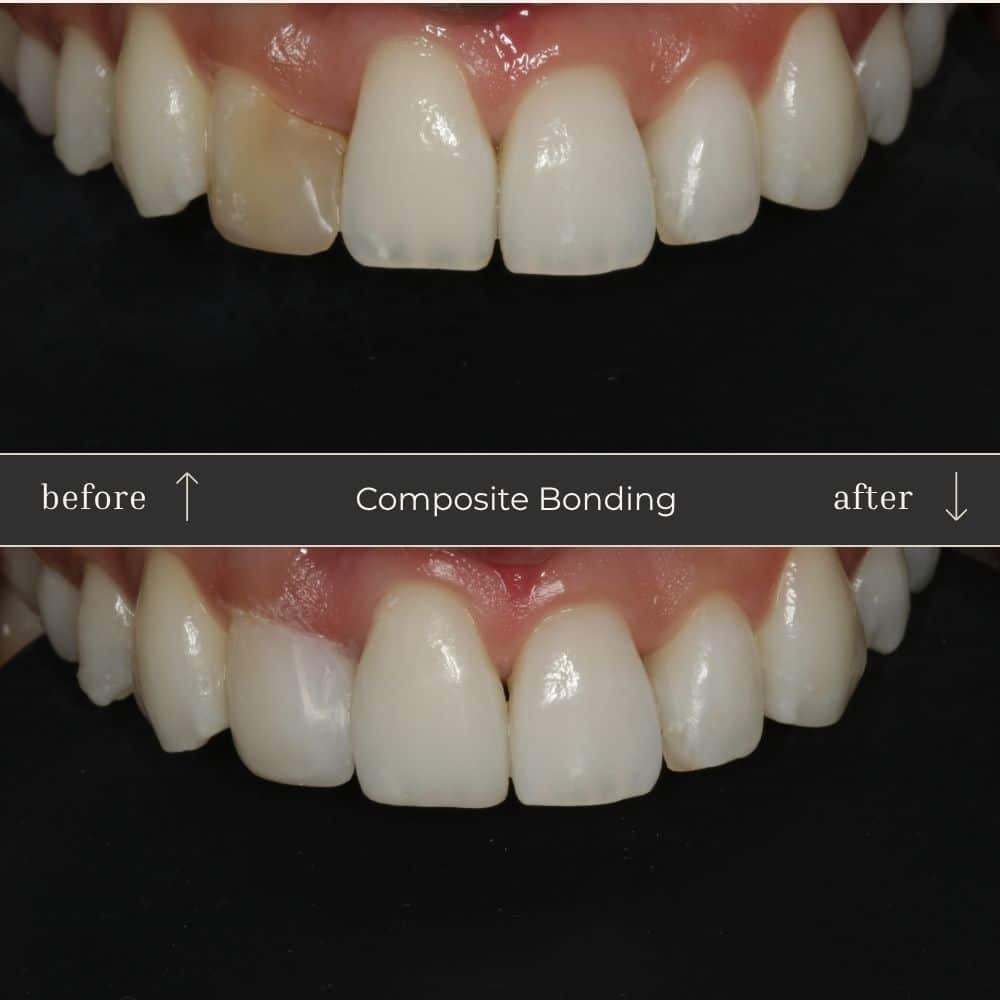 Composite Bonding Before & After