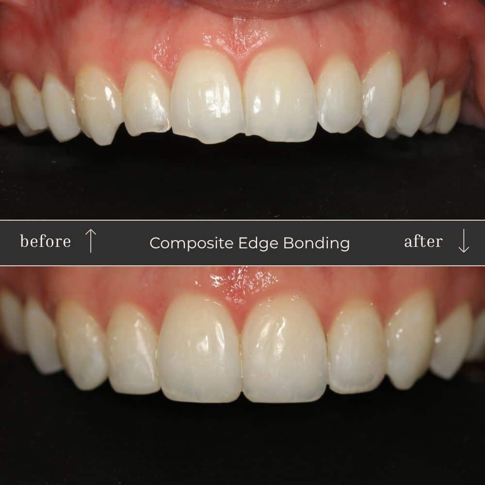 Composite Bonding Before & After
