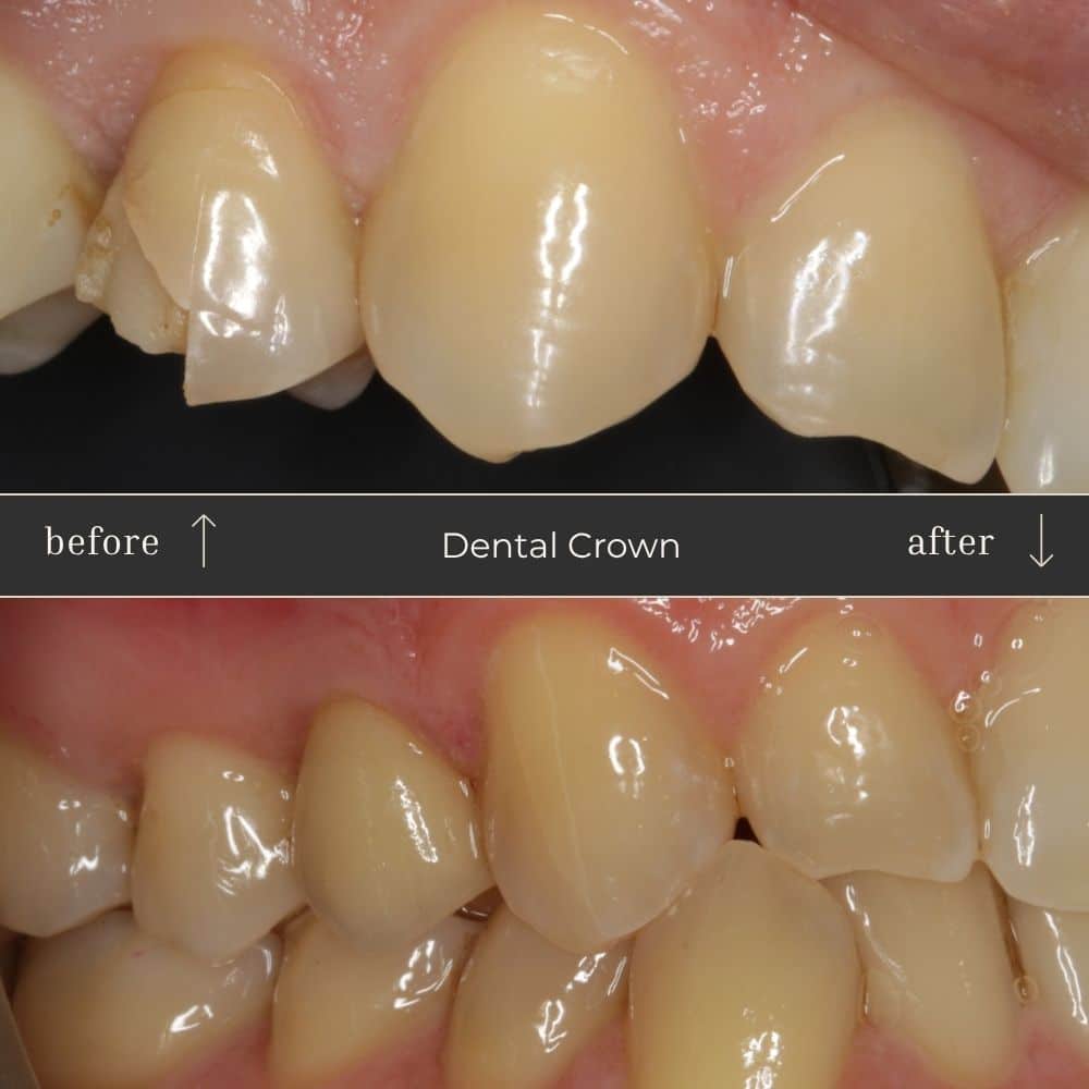 Dental Crown Before & After