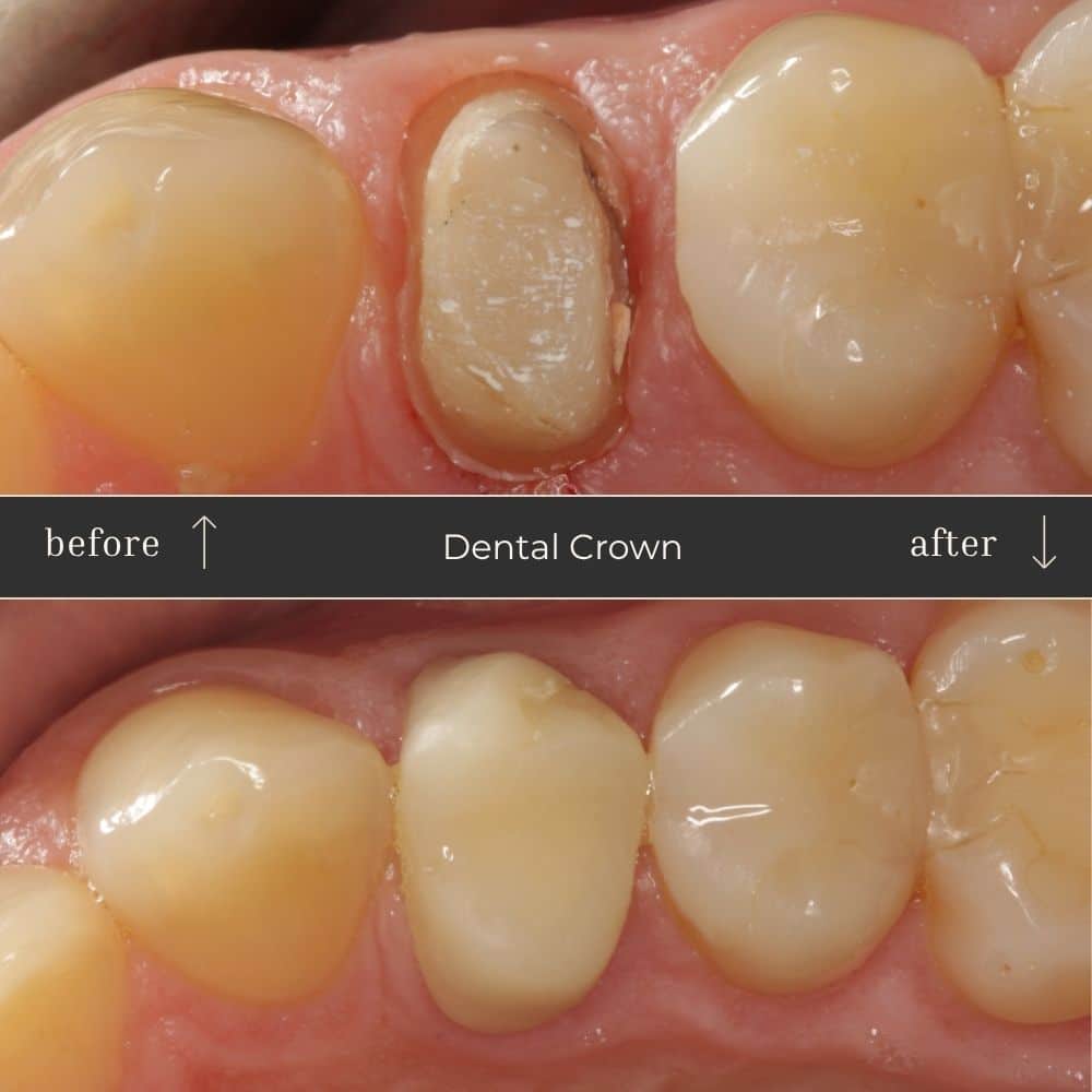 Dental Crown Before & After