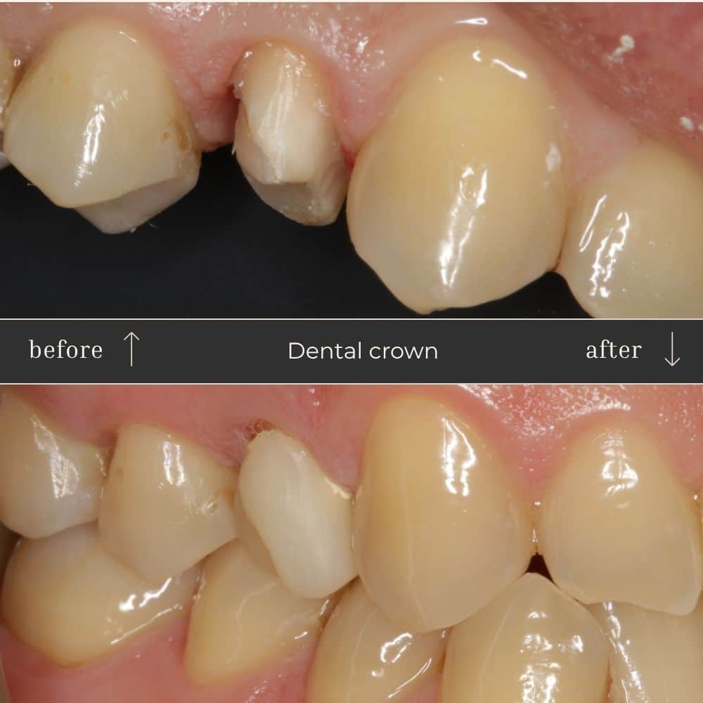 Dental crown Before & After