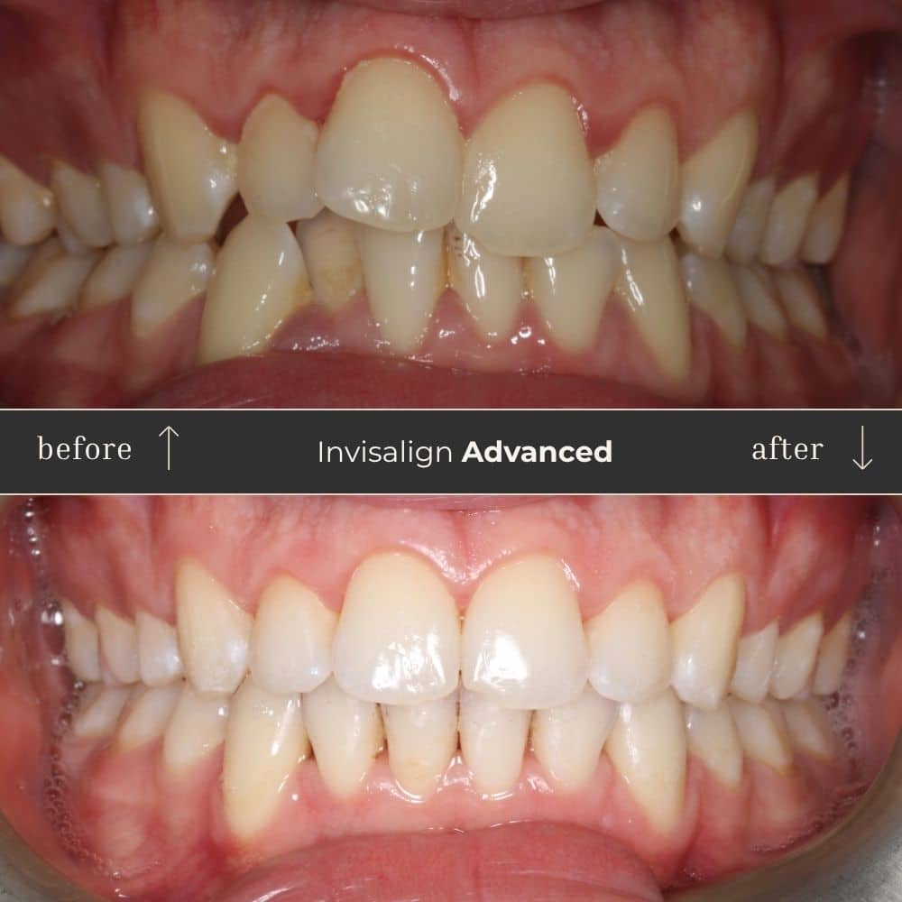 Invisalign Before & After