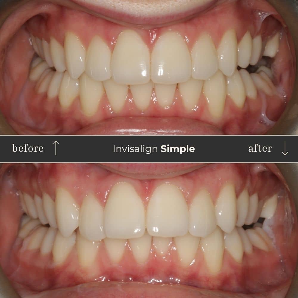 Invisalign Before & After