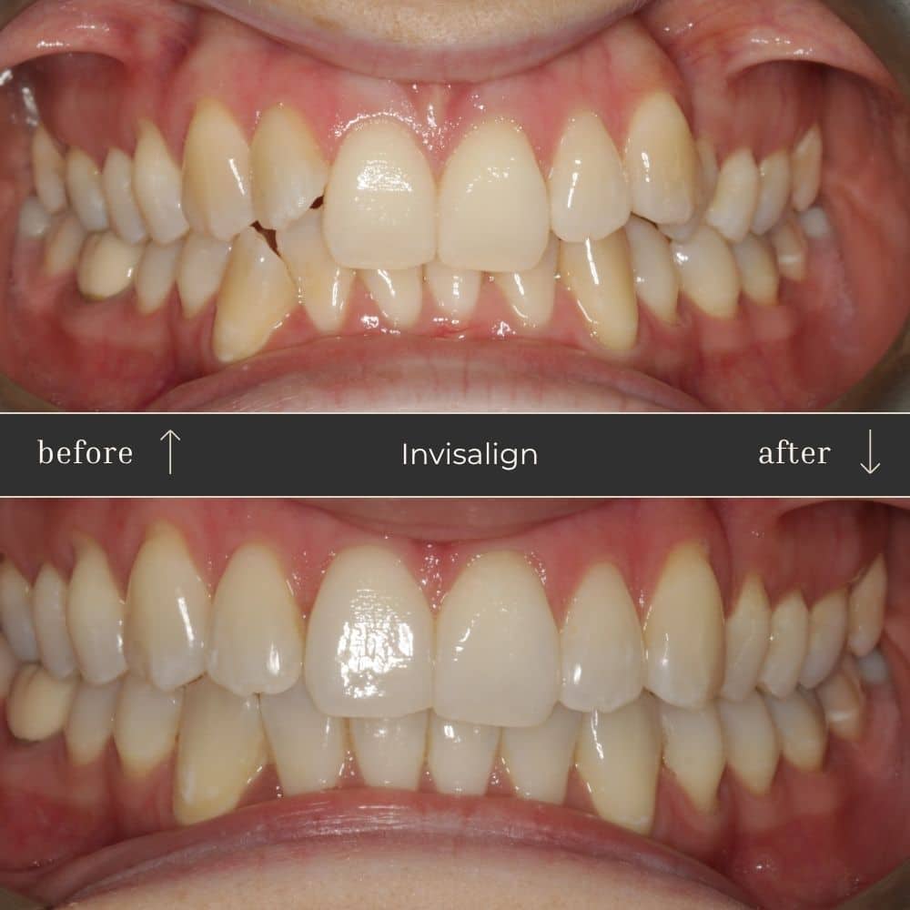 Invisalign Before & After