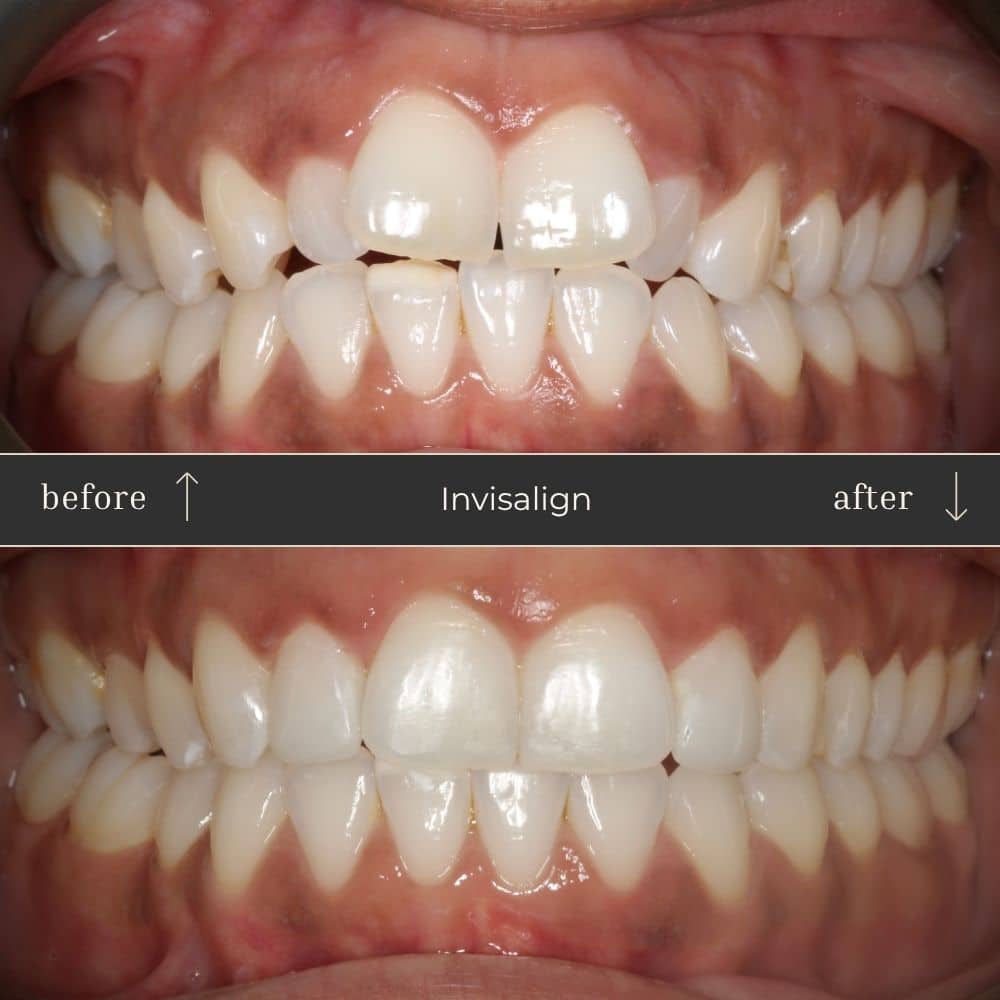 Invisalign Before & After