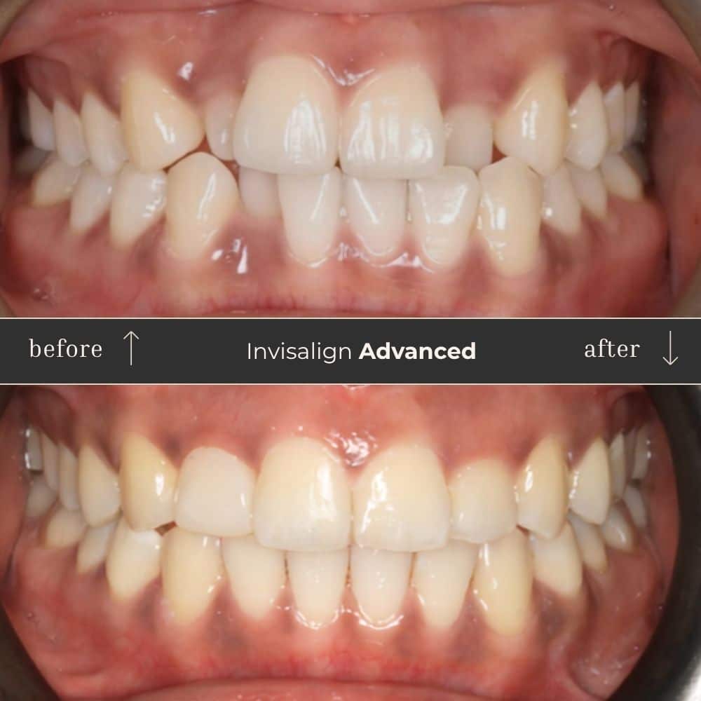 Invisalign Before & After