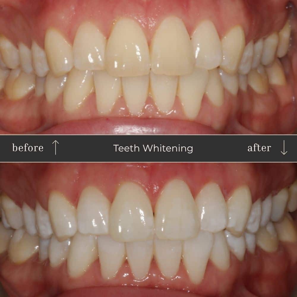 Mapperley Whitening- Before & Afters