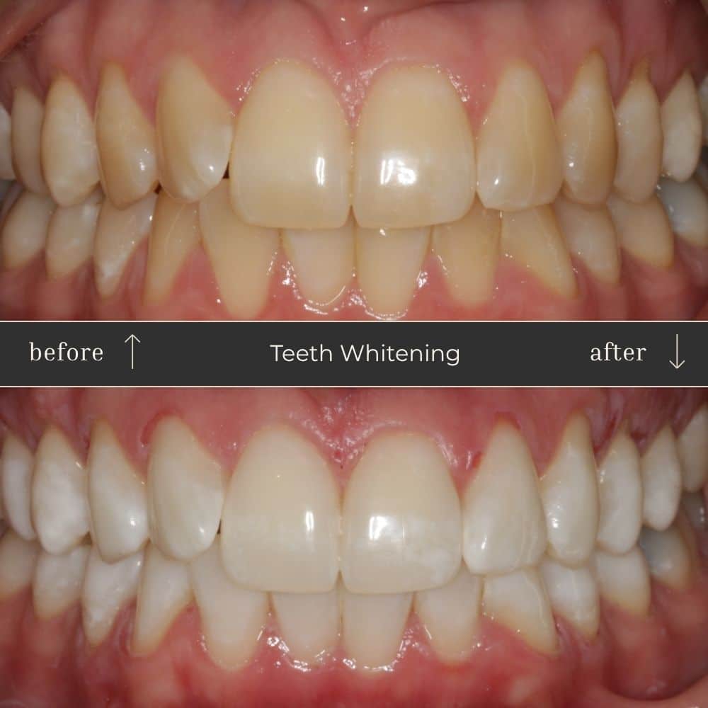 Mapperley Whitening- Before & Afters