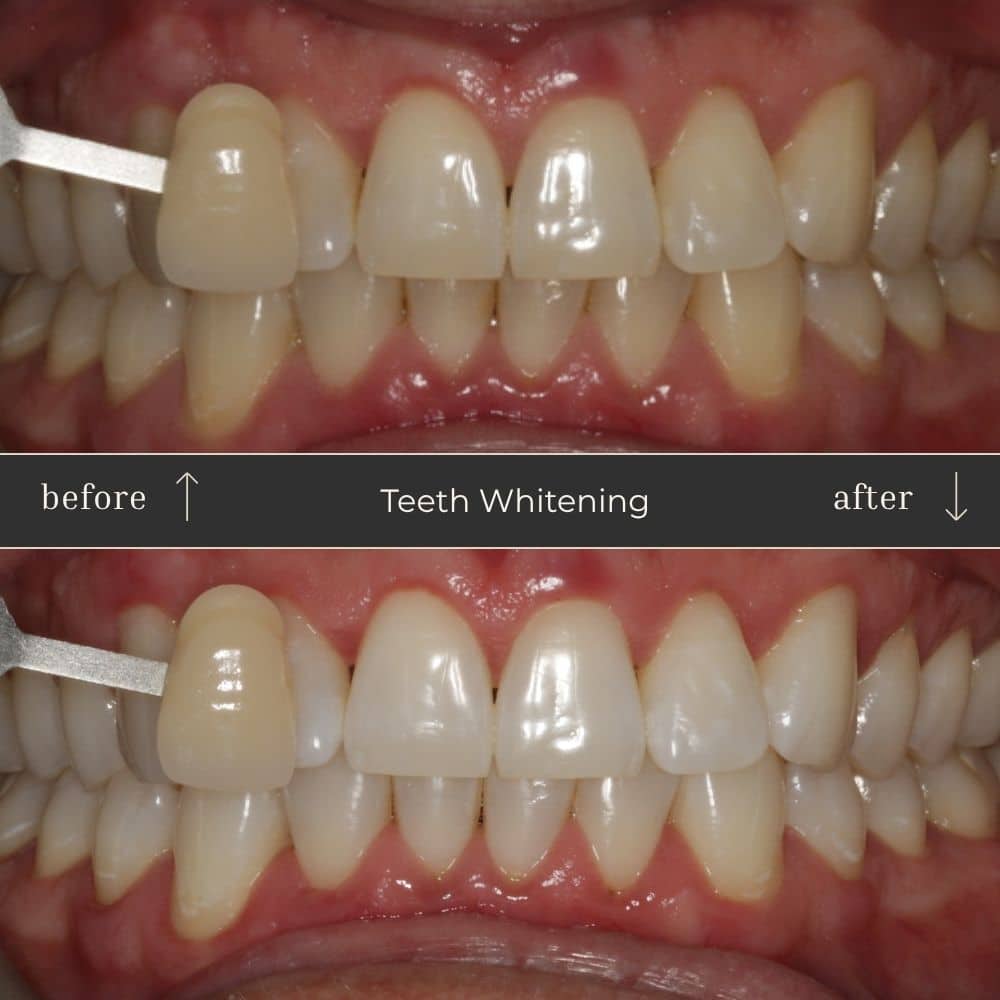 Mapperley Whitening- Before & Afters