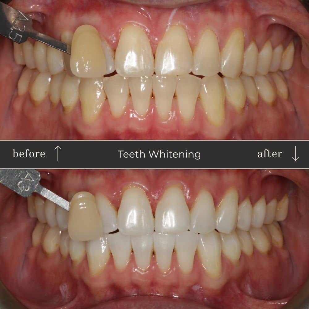 Mapperley Whitening- Before & Afters