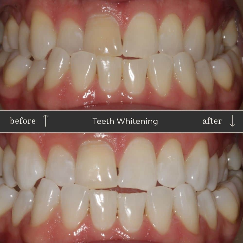 Mapperley Whitening- Before & Afters