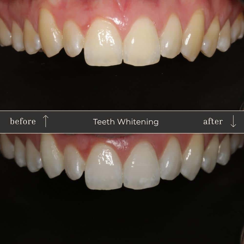 Mapperley Whitening- Before & Afters