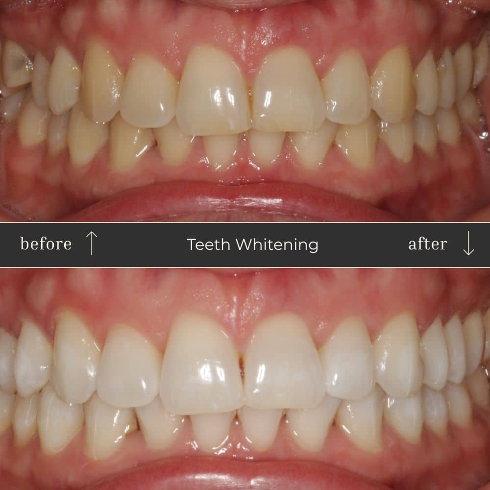 Mapperley Whitening- Before & Afters