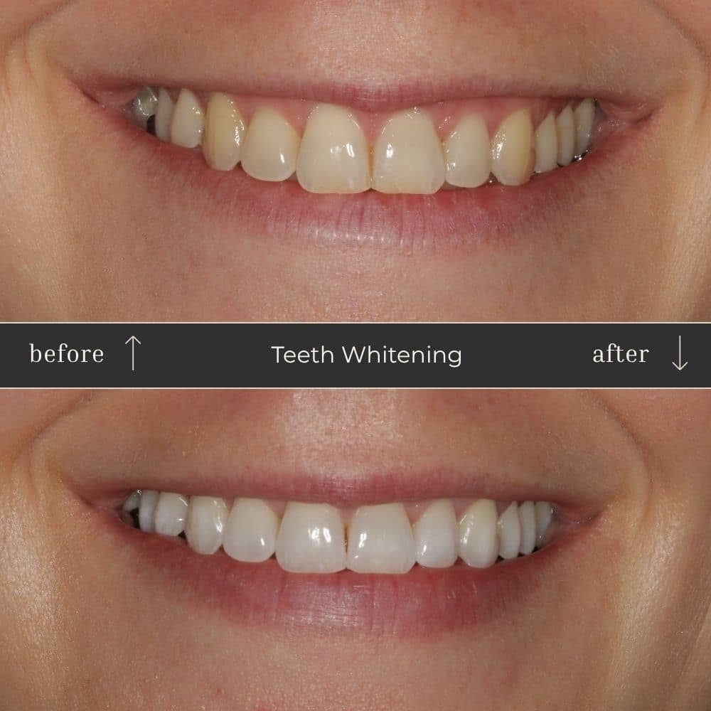 Mapperley Whitening- Before & Afters