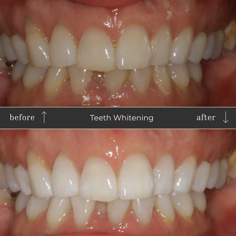 Mapperley Whitening- Before & Afters