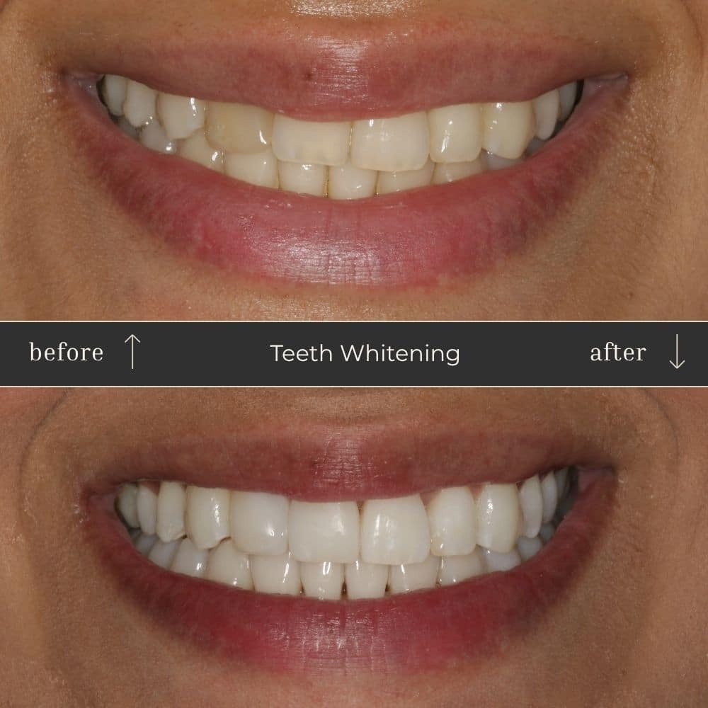 Mapperley Whitening- Before & Afters