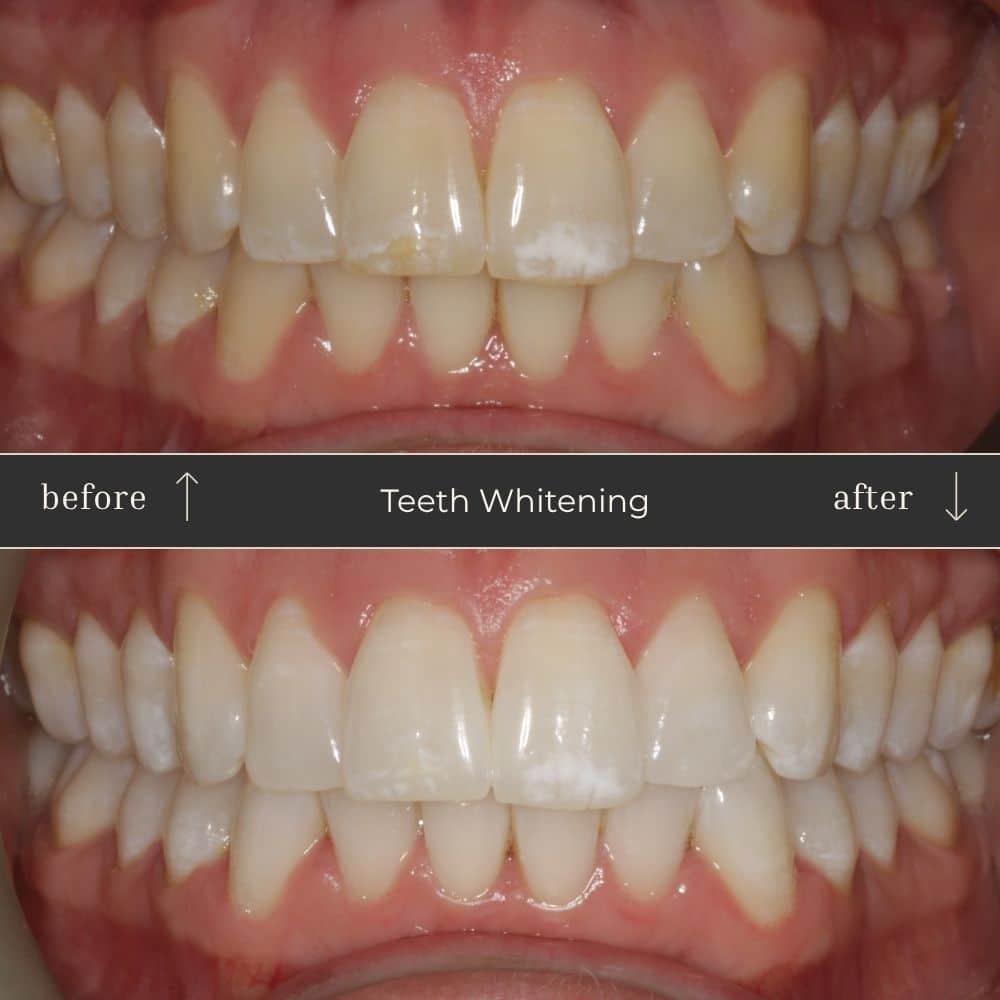 Mapperley Whitening- Before & Afters