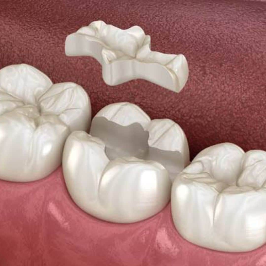 dental fillings in mapperley