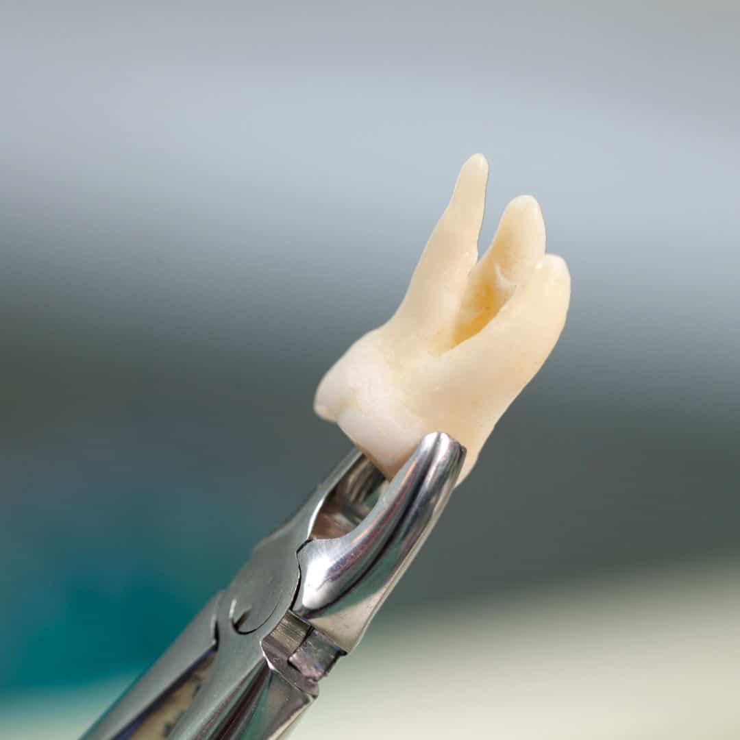 tooth removal in mapperley