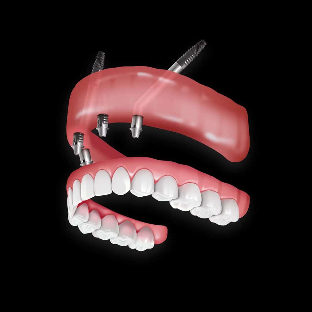 zygomatic implants in mapperley